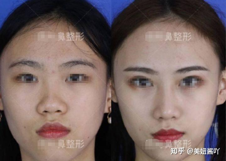 成都隆鼻專家前十名，專業(yè)技藝與信譽并重，成都隆鼻專家前十名，技藝與信譽并重的專業(yè)醫(yī)師