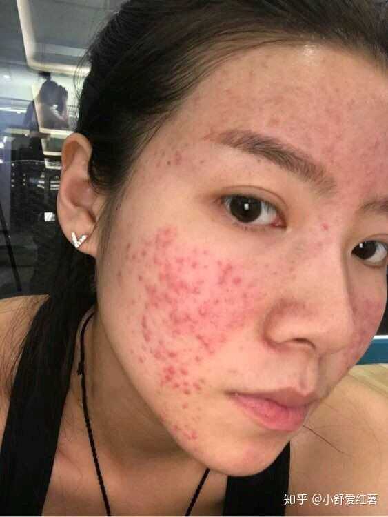 如何有效去除臉上的痘印——全方位指南，全方位指南，如何有效去除臉上痘印的方法