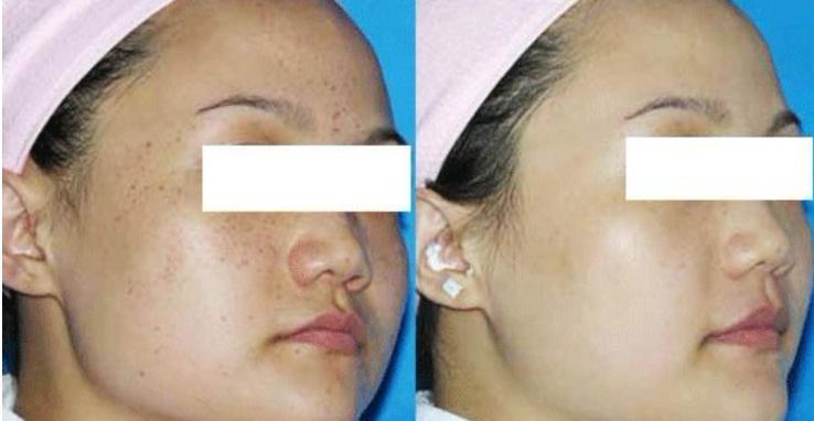 激光祛斑后需要注意的五大事項(xiàng)，激光祛斑后的五大注意事項(xiàng)詳解