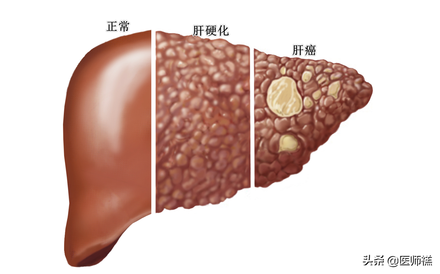 早期硬化的肝能治愈嗎，全面解析與希望，早期肝硬化能否治愈，全面解析與預(yù)后展望