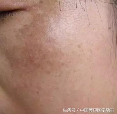 黃褐斑怎么治療最有效，全面解析最佳療法，全面解析黃褐斑最佳治療方法，最有效的療法選擇