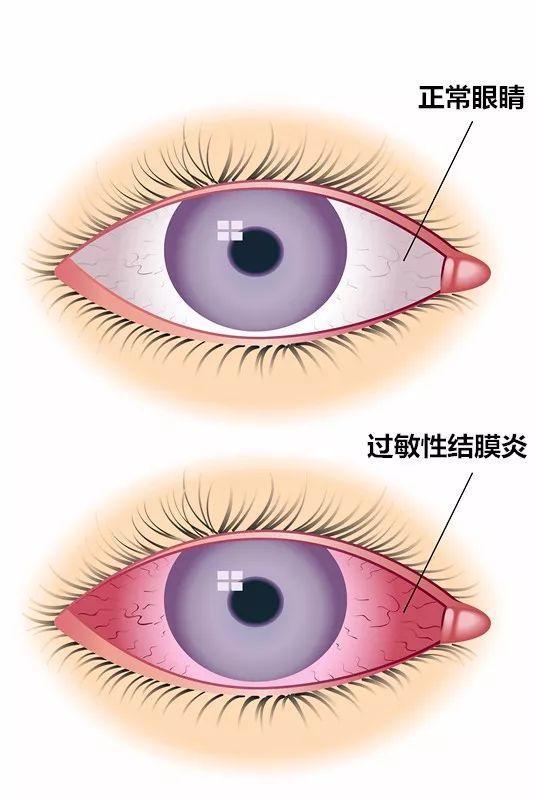 過敏性結(jié)膜炎，癥狀、原因及防治策略，過敏性結(jié)膜炎詳解，癥狀、成因與防治策略