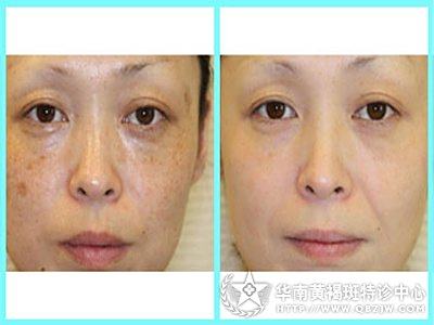 中醫(yī)祛斑最有效的方法，中醫(yī)祛斑有效方法總結(jié)，探索最佳祛斑途徑