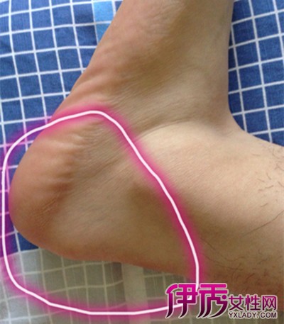 腳后跟疼的原因及治療方法，全面解析與應對之道，腳后跟疼痛解析，成因、治療方法與應對之道