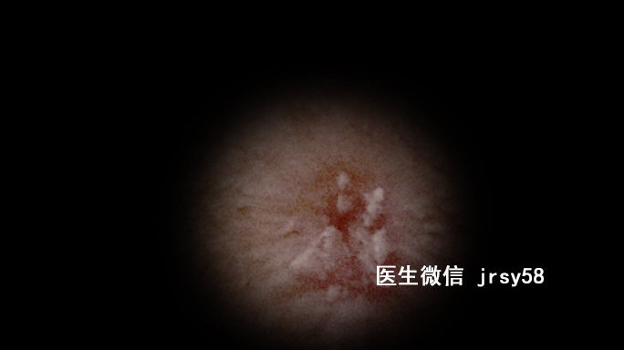 尖銳濕疹，深入了解與治療建議，尖銳濕疹，深度解析與治療指南