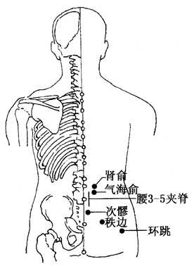 坐骨神經(jīng)痛的治療方法，哪種方式能最快緩解你的疼痛？，坐骨神經(jīng)痛快速緩解方法與治療方式探討