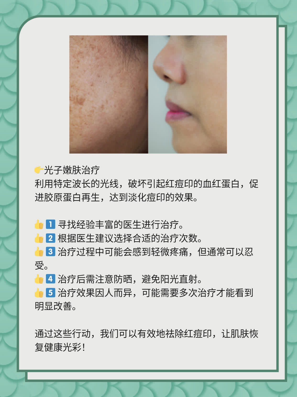 如何有效去除紅痘印，一站式解決方案，一站式解決紅痘印問(wèn)題，有效去除方法大全