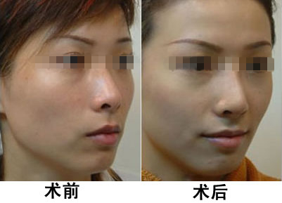 光子嫩膚做一次有效嗎？深入了解光子嫩膚的效果與過程，光子嫩膚效果與過程解析，做一次是否有效？