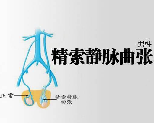 精索靜脈曲張的癥狀表現(xiàn)及其影響，精索靜脈曲張的癥狀表現(xiàn)及其潛在影響