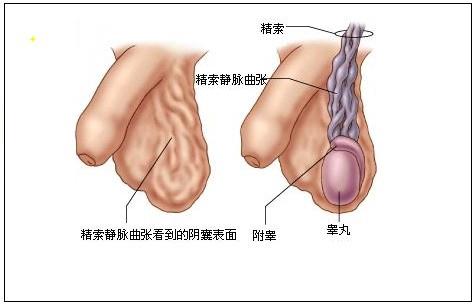 精索靜脈曲張，了解、預防與治療，精索靜脈曲張，全面解析了解、預防與治療策略