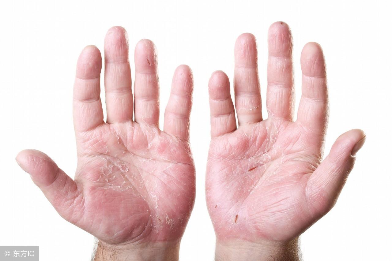 濕疹怎么治療，全面解析有效的治療方法，全面解析濕疹的有效治療方法