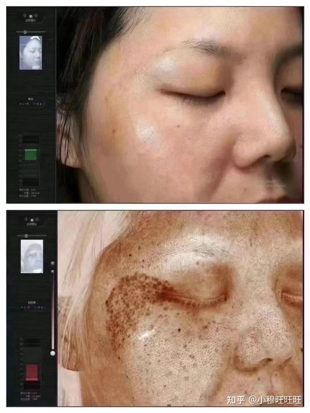 激光祛斑，選擇醫(yī)院還是美容院？全面解讀助您做出明智決策，激光祛斑，如何選擇醫(yī)院與美容院？全面解讀為您指明決策方向
