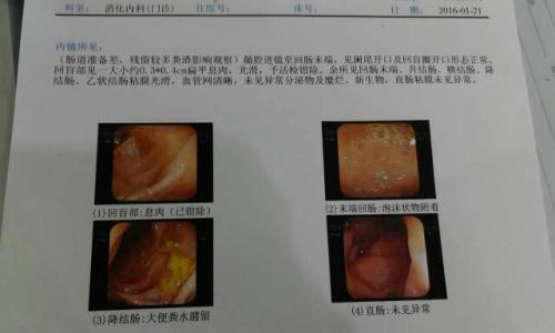 如何判斷痔瘡還是息肉，癥狀、診斷與治療方法，痔瘡與息肉，癥狀、診斷及治療方法詳解
