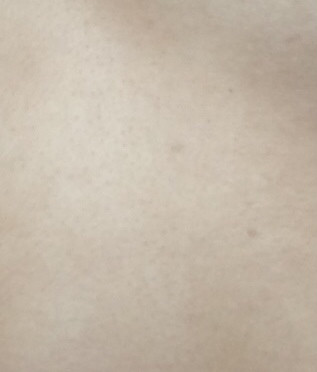 身上長紅色點點是怎么回事？全面解析皮膚異?，F(xiàn)象，皮膚異?，F(xiàn)象解析，身上長紅色點點的可能原因與解析