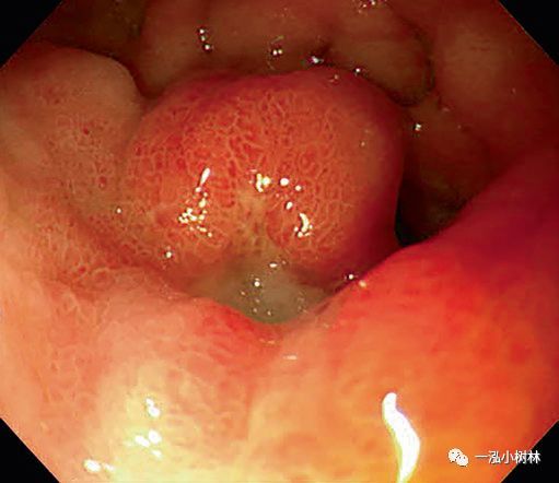 十二指腸潰瘍，成因、癥狀及防治策略，十二指腸潰瘍，成因、癥狀與防治方法全解析