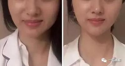 瘦臉針打三次就可以永久定型了嗎？深度解析瘦臉針效果與注意事項，深度解析，瘦臉針效果及注意事項——打三次能否永久定型？