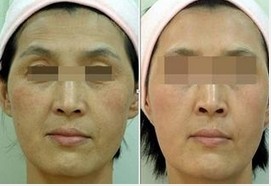 面部除皺針，價格因素與選擇指南，面部除皺針，價格因素與選擇指南詳解