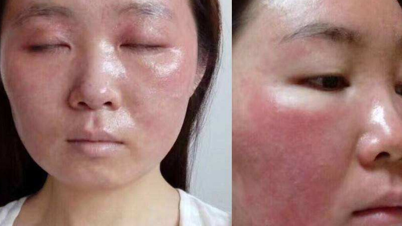 激素臉的正確修復方法，激素臉的正確修復方法與步驟