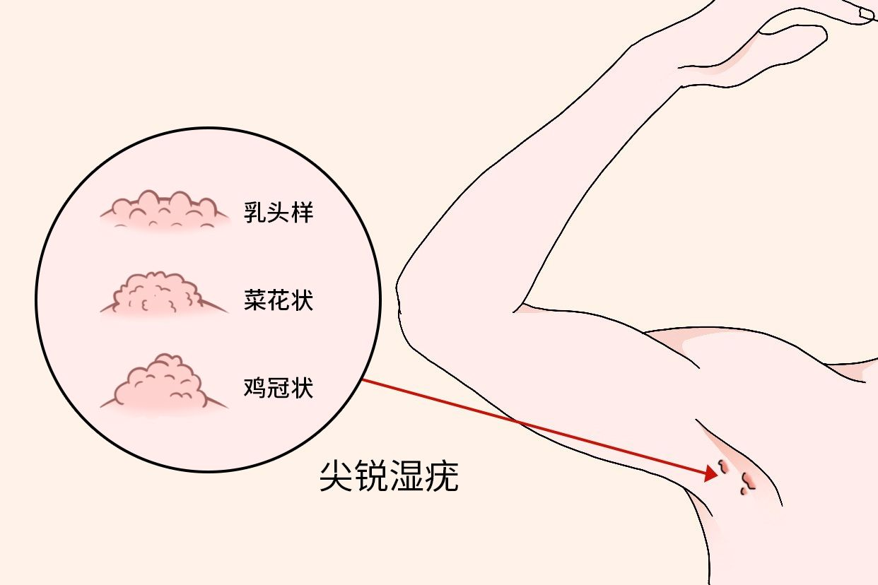 尖銳濕疣圖片，了解、識(shí)別與防治，尖銳濕疣圖片詳解，識(shí)別、防治全攻略