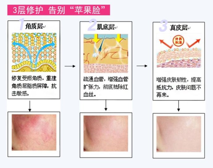 治療紅血絲的最佳方法，治療紅血絲的最佳方法簡述