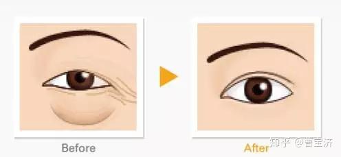 尋找最佳的眼袋治療醫(yī)院，專業(yè)解析與推薦，專業(yè)解析眼袋治療醫(yī)院推薦，助您尋找最佳治療機構