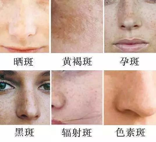 如何有效去除臉上斑點——全方位指南，全方位指南，如何有效去除臉上斑點