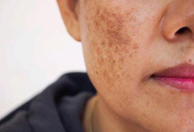 最簡(jiǎn)單除老年斑的偏方，最簡(jiǎn)單有效的老年斑去除偏方